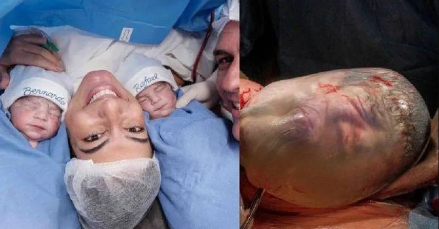 43歲巴西女子誕下雙胞胎，男嬰是罕見的「人魚寶寶」