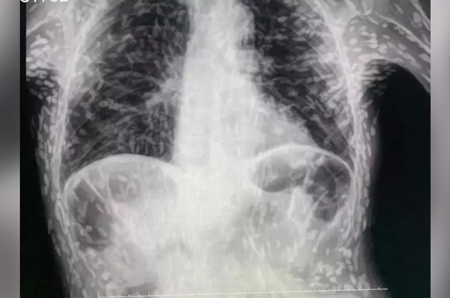 巴西男子因持續咳嗽兩個月後驚覺體內「寄生蟲」，X光檢查揭示驚人發現
